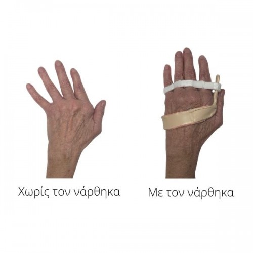Κηδεμόνας ειδικής κατασκευής για ρευματοειδή αρθρίτιδα δακτύλων χειρός Κηδεμόνας ειδικής κατασκευής για ρευματοειδή αρθρίτιδα δακτύλων χειρός