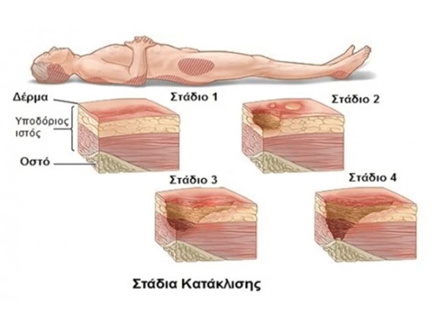 Πρόληψη και θεραπεία κατακλίσεων
