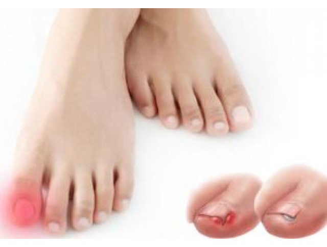 Ονυχοκρύπτωση (ή είσφρυση όνυχος)