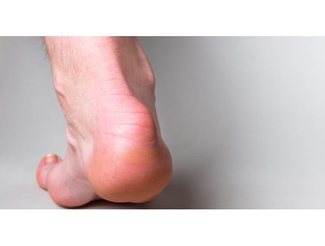 Οπισθοπτερνική θυλακίτιδα Οπισθοπτερνική θυλακίτιδα