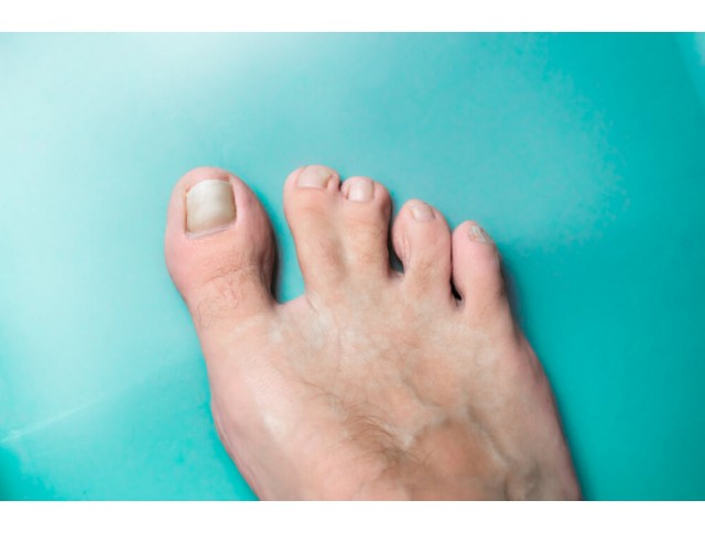 Συνδακτυλία Συνδακτυλία