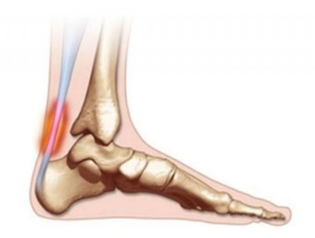 Ρήξη αχιλλείου τένοντα Ρήξη αχιλλείου τένοντα