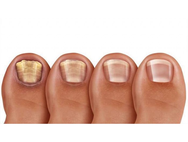 Υπερτροφία Νυχιών: Αιτίες, Συμπτώματα και Αντιμετώπιση