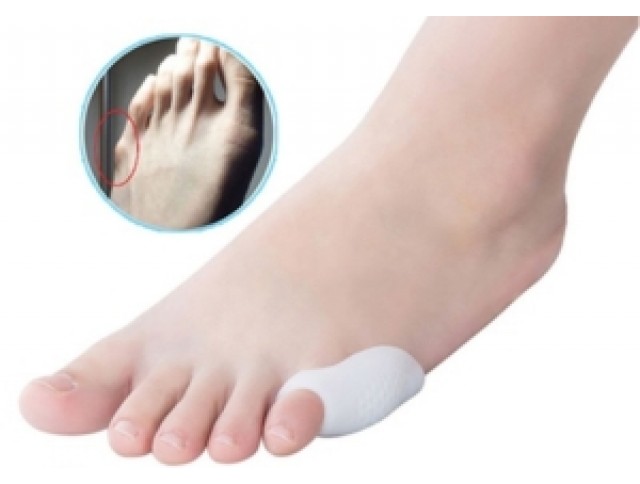 Κότσι του Ράφτη (bunionette) Κότσι του Ράφτη (bunionette)