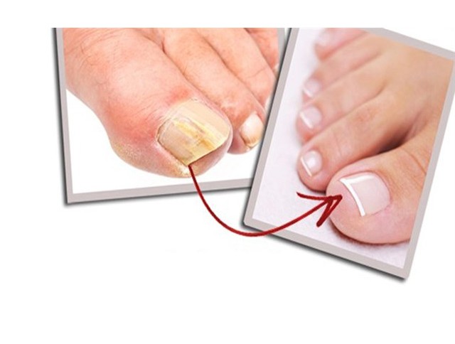 Ονυχομυκητίαση