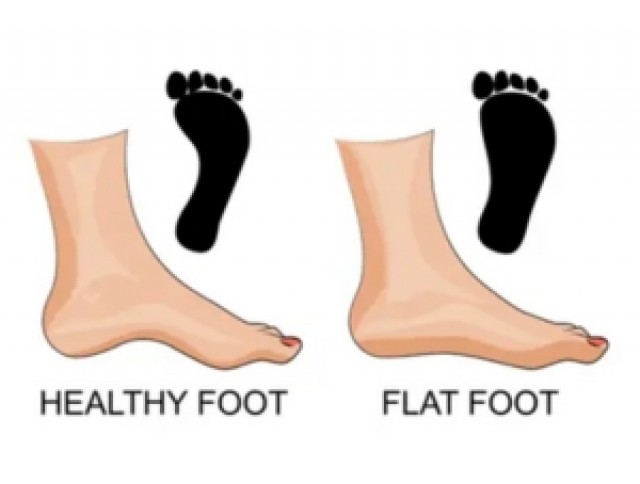 Πλατυποδία