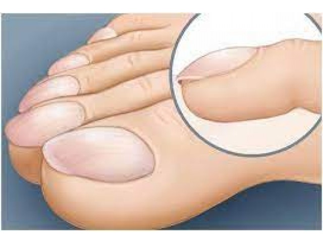 Πληκτροδακτυλία