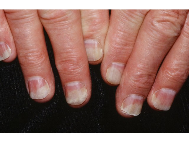 Στιγμοειδείς εμβυθίσεις (βοθρία)