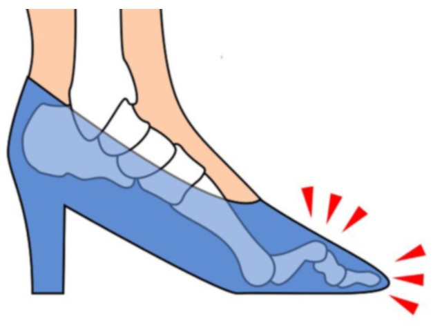 Σφυροδακτυλία Σφυροδακτυλία