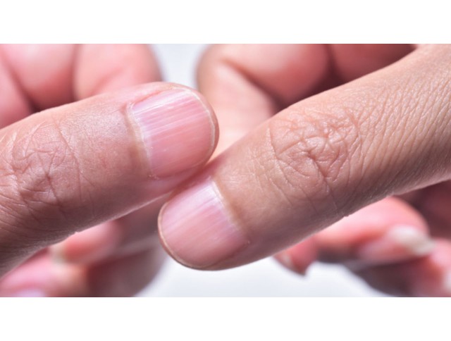 Γραμμές του Beau