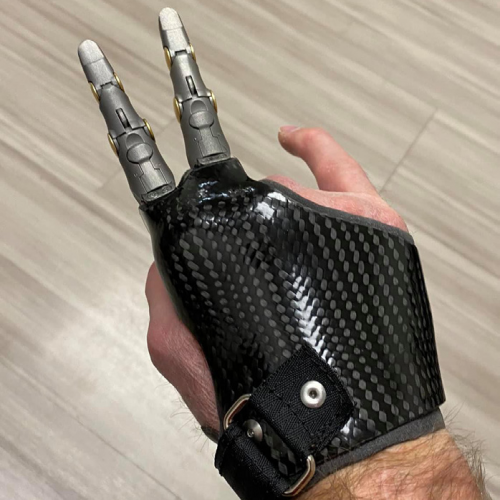 Πρόθεση δακτύλων μηχανική ή πρόθεση τμημάτων παλάμης μηχανική