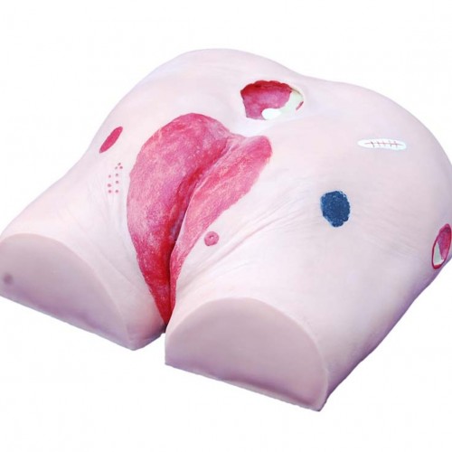 Μοντέλο φροντίδας έλκους κατάκλισης