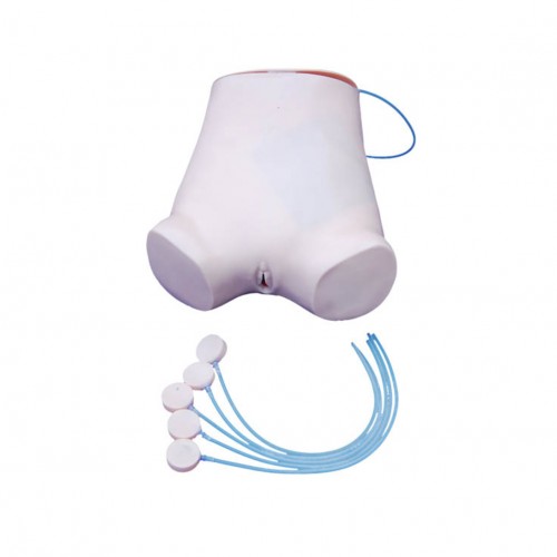 Πρόπλασμα κοιλιακής παρακέντησης