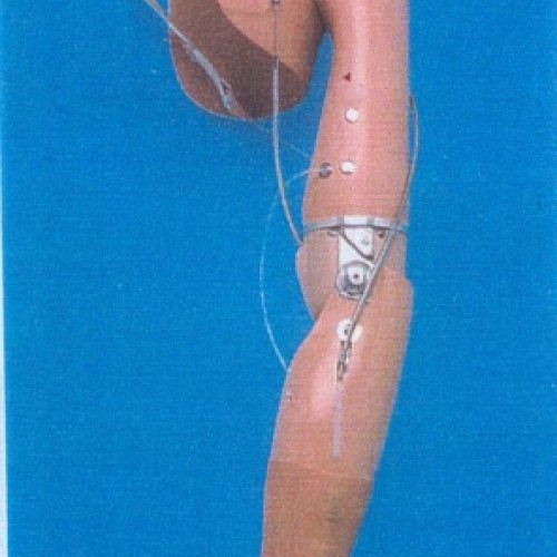 Πρόθεση  ώμου - απεξάρθρωσης βραχιονίου μηχανική