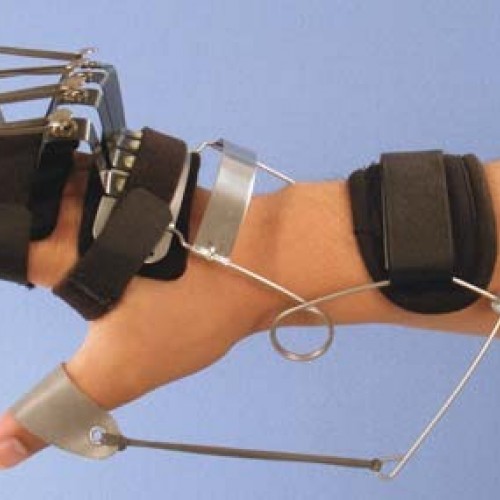 Νάρθηκας έκτασης καρπού, έκτασης μετακαρπίων με έλεγχο των δακτύλων Νάρθηκας έκτασης καρπού, έκτασης μετακαρπίων με έλεγχο των δακτύλων