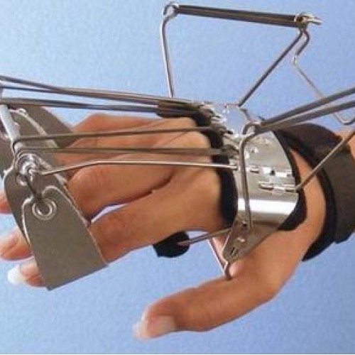 Δυναμικός νάρθηκας έκτασης των μετακαρπίων με έλεγχο της έκτασης Δυναμικός νάρθηκας έκτασης των μετακαρπίων με έλεγχο της έκτασης