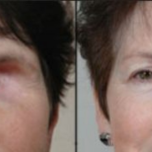 Πρόθεση ματιού Πρόθεση ματιού