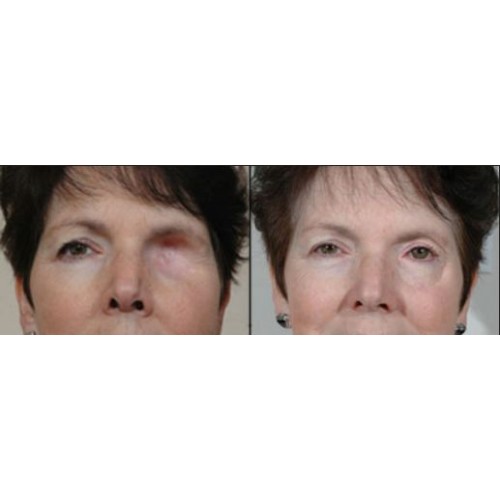 Πρόθεση ματιού Πρόθεση ματιού