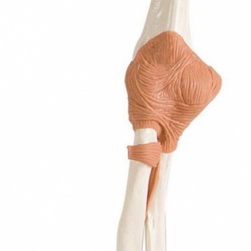 Πρόπλασμα λειτουργικής άρθρωσης αγκώνος Πρόπλασμα λειτουργικής άρθρωσης αγκώνος