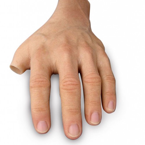 Πρόθεση τμήματος παλάμης εξατομικευμένης κατασκευής