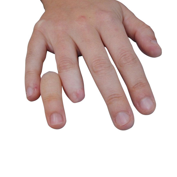 Πρόθεση δακτύλων χεριού εξατομικευμένης κατασκευής