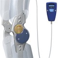 Μηροκνημοποδικός κηδεμόνας με μηχανική άρθρωση αυτόματης ασφάλισης/απασφάλισης γόνατος