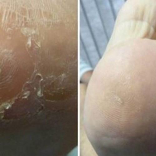 Θεραπευτική αντιμετώπιση κάλων, σκληρύνσεων, υπερκερατώσεων Θεραπευτική αντιμετώπιση κάλων, σκληρύνσεων, υπερκερατώσεων