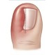 Onyclip Set Σύστημα Διόρθωσης Νυχιών