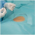Χειρουργικά πεδία protect με οπή 7cm και αυτοκόλλητο