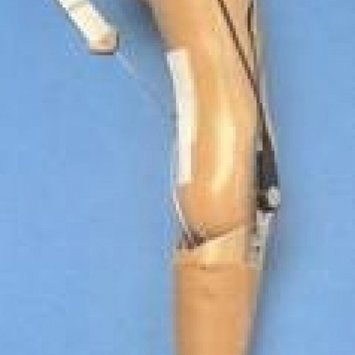 Προθέση βραχιονίου ή απεξάρθρωσης αγκώνα μηχανική Προθέση βραχιονίου ή απεξάρθρωσης αγκώνα μηχανική