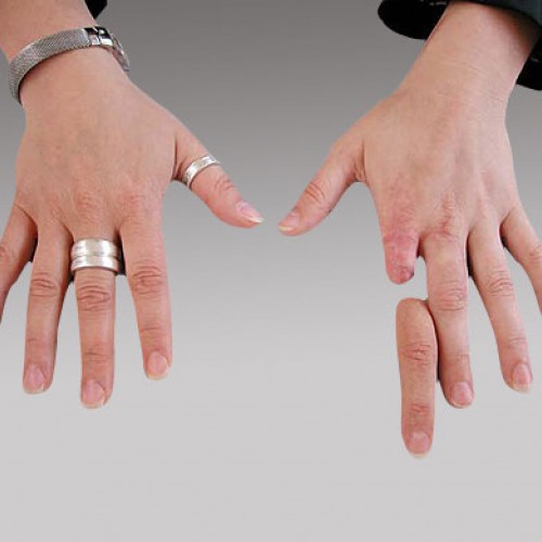 Πρόθεση δακτύλων χεριού εξατομικευμένης κατασκευής