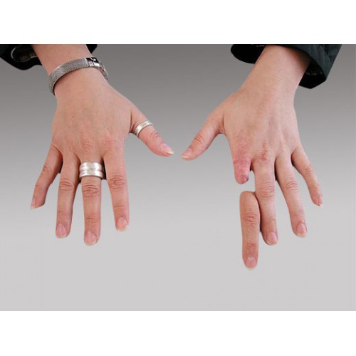 Πρόθεση δακτύλων χεριού εξατομικευμένης κατασκευής Πρόθεση δακτύλων χεριού εξατομικευμένης κατασκευής