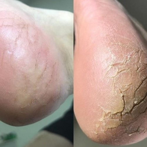 Θεραπευτική αντιμετώπιση ραγάδων και σκλήρυνσης πτέρνας Θεραπευτική αντιμετώπιση ραγάδων και σκλήρυνσης πτέρνας