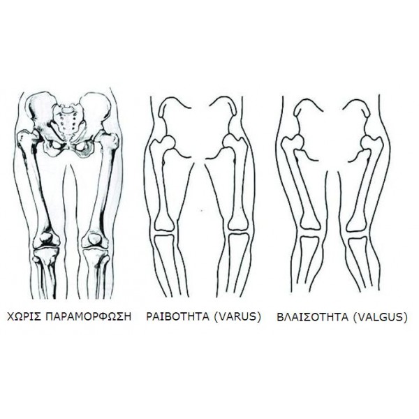 Μεταλλικός μηροκνημικός νάρθηκας οστεοαρθρίτδας γόνατος