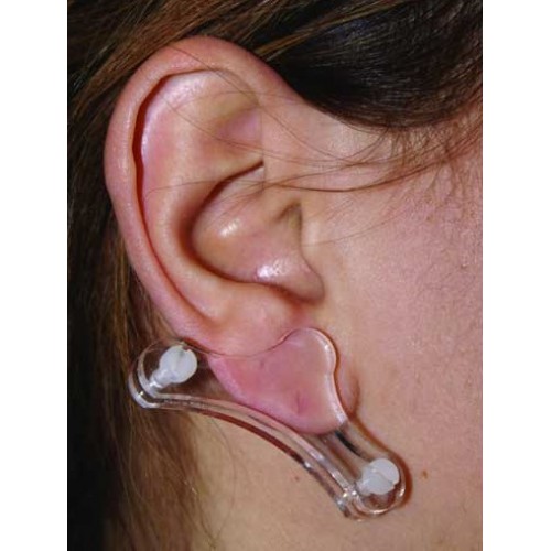 Πίεστρα αυτιού για χηλοειδές Πίεστρα αυτιού για χηλοειδές