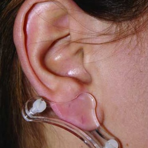 Πίεστρα αυτιού για χηλοειδές Πίεστρα αυτιού για χηλοειδές