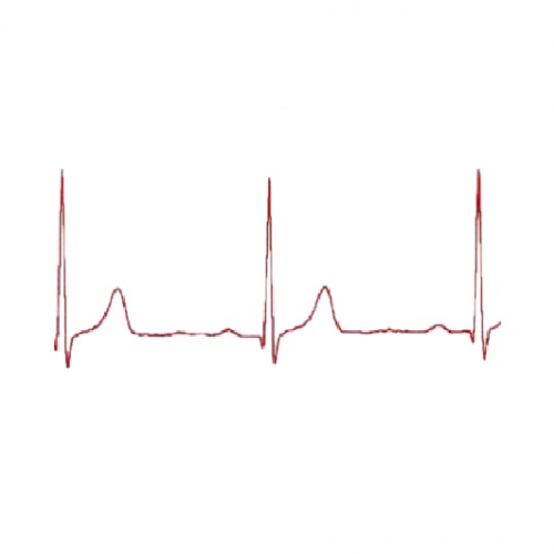 Ηλεκτροκαρδιογράφημα χωρίς διάγνωση