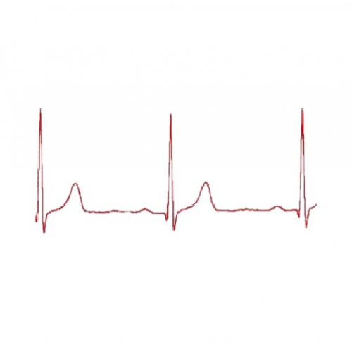 Ηλεκτροκαρδιογράφημα χωρίς διάγνωση