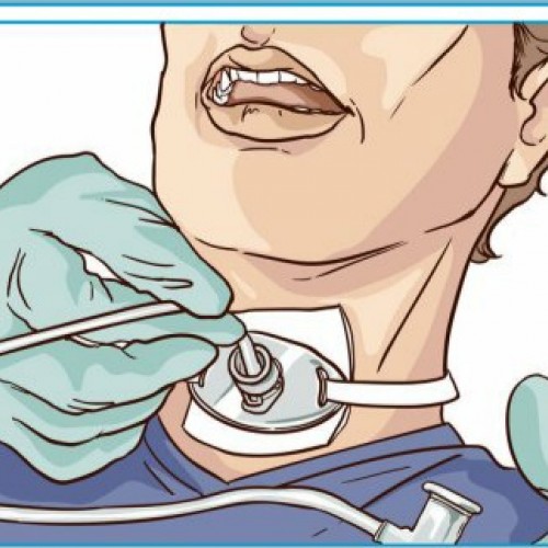 Αναρρόφηση βρογχικών εκκρίσεων