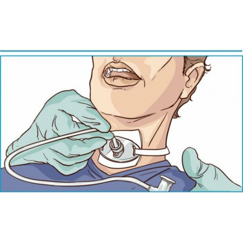 Αναρρόφηση βρογχικών εκκρίσεων