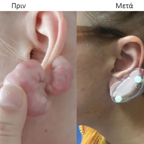 Πίεστρο αυτιού για χηλοειδές με σιλικόνη Πίεστρο αυτιού για χηλοειδές με σιλικόνη