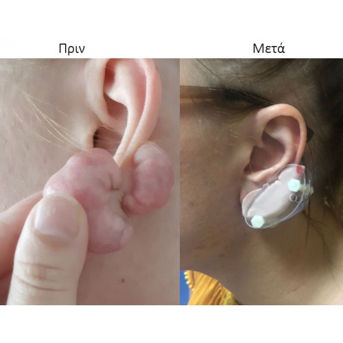 Πίεστρο αυτιού για χηλοειδές με σιλικόνη Πίεστρο αυτιού για χηλοειδές με σιλικόνη