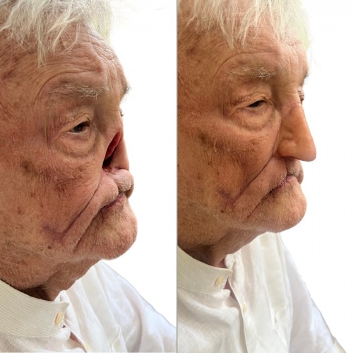 Πρόθεση μύτης Πρόθεση μύτης